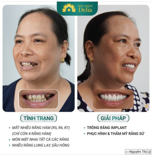 TRỒNG RĂNG IMPLANT - khắc phục ngay tình trạng mất răng