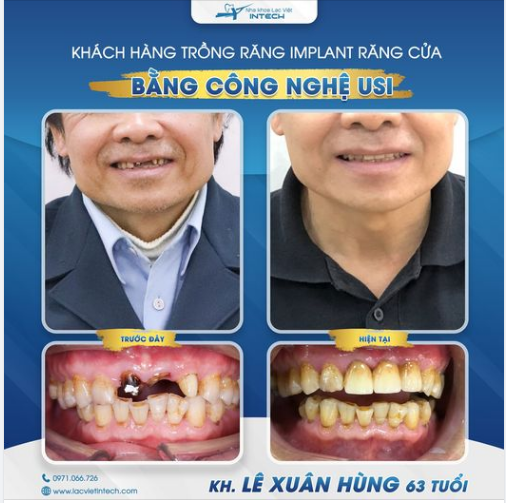 TRỒNG RĂNG IMPLANT - KHÔI PHỤC RĂNG CỬA VẸN NGUYÊN CHỈ SAU 24H