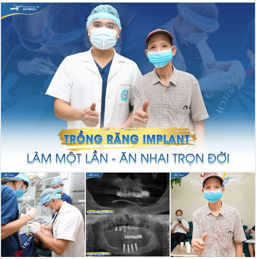 TRỒNG RĂNG IMPLANT - LÀM MỘT LẦN - ĂN NHAI TRỌN ĐỜI