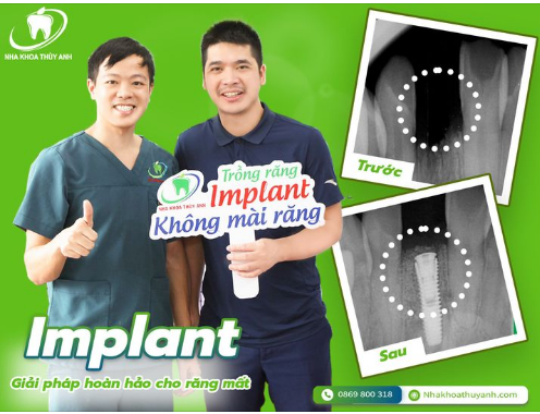 TRỒNG RĂNG IMPLANT LÀM MỘT LẦN ĂN TRỌN ĐỜI