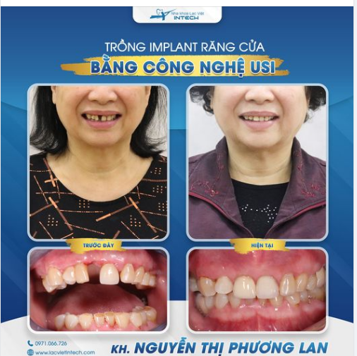TRỒNG RĂNG IMPLANT: LẤY LẠI NỤ CƯỜI DUYÊN Ở TUỔI 58