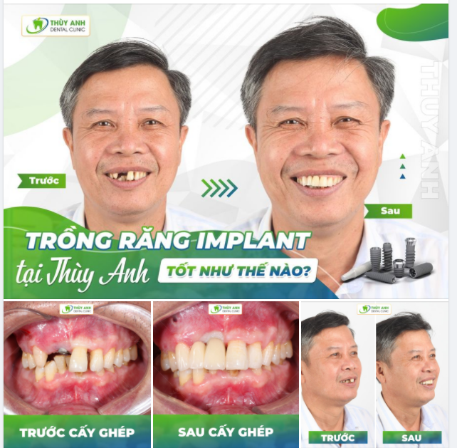 TRỒNG RĂNG IMPLANT Ở NHA KHOA THÙY ANH TỐT NHƯ THẾ NÀO