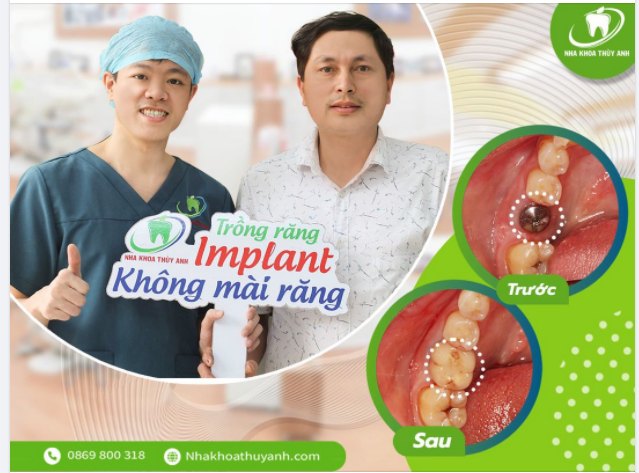 TRỒNG RĂNG IMPLANT - THẨM MỸ TUYỆT ĐỐI, ĂN NHAI TUYỆT VỜI