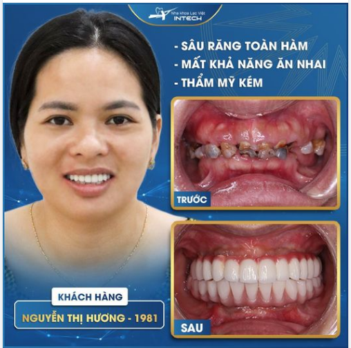 TRỒNG RĂNG IMPLANT TOÀN HÀM BẰNG CÔNG NGHỆ USI MỘT LẦN, ĂN NHAI THOẢI MÁI MỘT ĐỜI