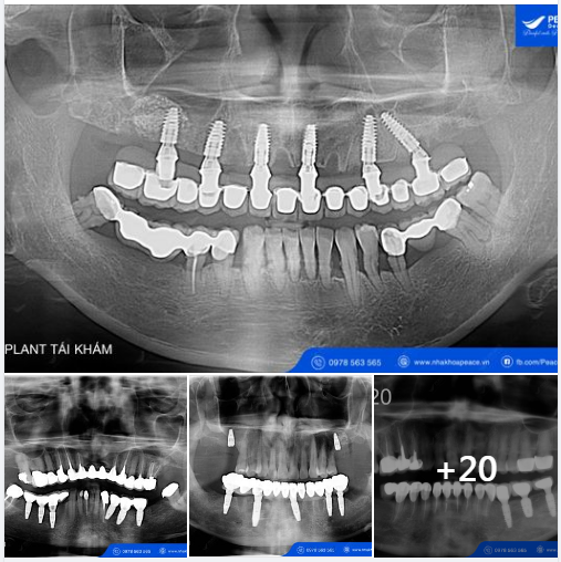 TRỒNG RĂNG IMPLANT TỐT NHƯ THẾ NÀO?
