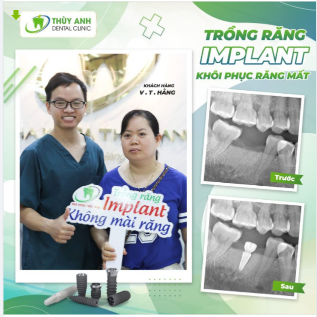 TRỒNG RĂNG IMPLANT TRỌN GÓI CHỈ 6.9TR.Đ