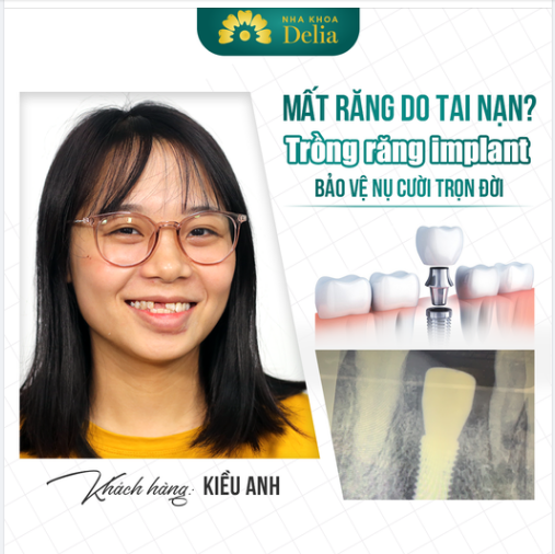 Trồng răng sớm để bảo vệ nụ cười - trồng răng BIO IMPLANT độc quyền tại Delia