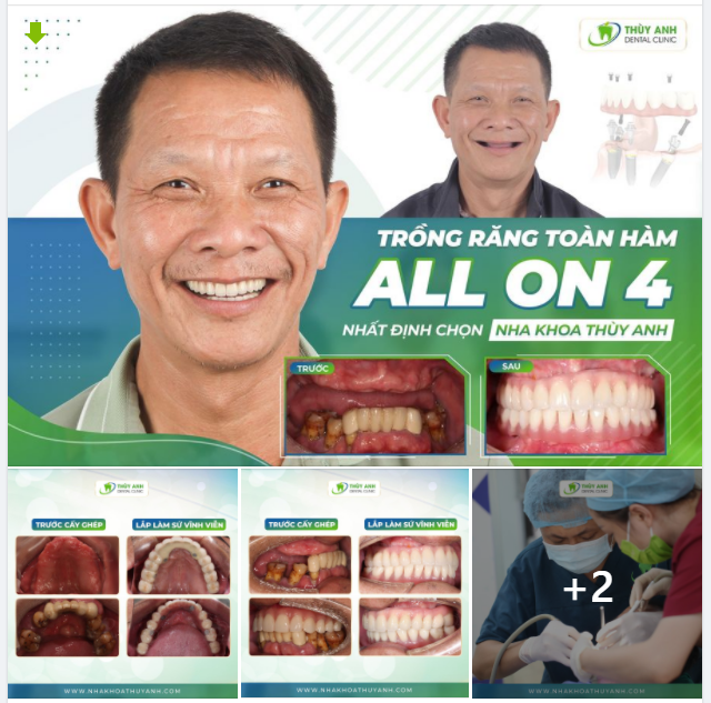 TRỒNG RĂNG TOÀN HÀM ALL ON 4 NHẤT ĐỊNH PHẢI CHỌN NHA KHOA THÙY ANH
