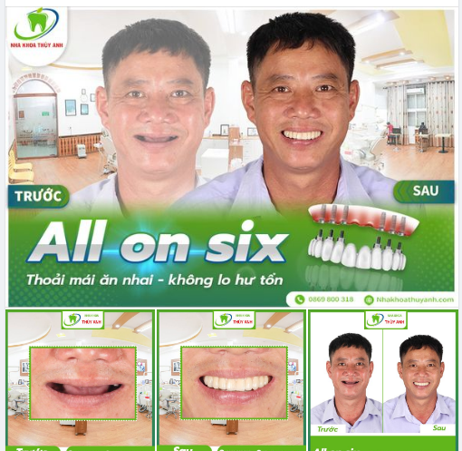 TRỒNG RĂNG TOÀN HÀM KHÔNG ĐAU, ĂN NHAI THOẢI MÁI
