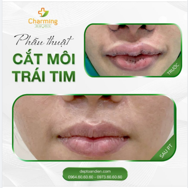 Trong thời gian chờ cắt chỉ sau phẫu thuật cắt môi trái tim thì nhìn vào phần môi thấy hơi bị sợ .-. Nhưng mà khi cắt chỉ, môi lành rồi thì dáng môi hơi bị đẹp luôn đó nha chị em