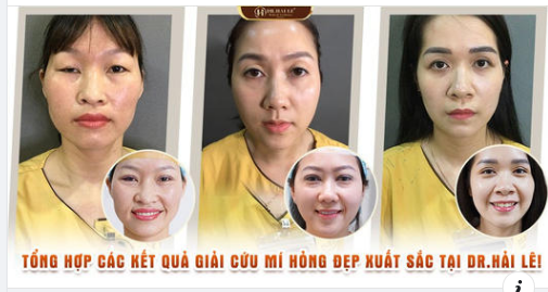 Trót cắt mí tại cơ sở kém uy tín bị hỏng, lỗi. PHẢI LÀM SAO