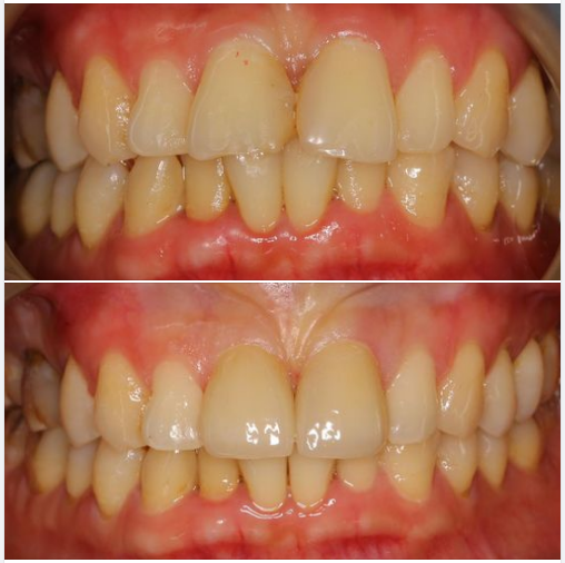 Trường hợp này là 2 răng cửa đã được gắn Veneer sứ EMAX