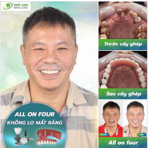 "TỪ NGÀY CÓ RĂNG MỚI CHÚ THẤY CHÚ ĐẸP TRAI HƠN HẲN"