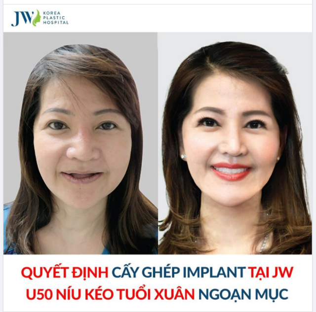 TỪ NHỮNG ĐỐM ĐEN LI TI, U50 THẲNG TAY CƯA SẠCH RĂNG, KẾT QUẢ ĐEO HÀM GIẢ SUỐT 10 NĂM