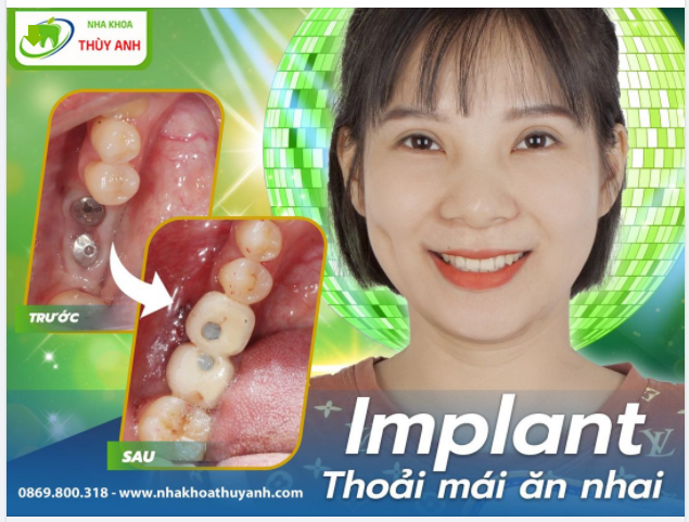 TỰ TIN ĂN NHAI CẢ THẾ GIỚI CÙNG VỚI RĂNG IMPLANT