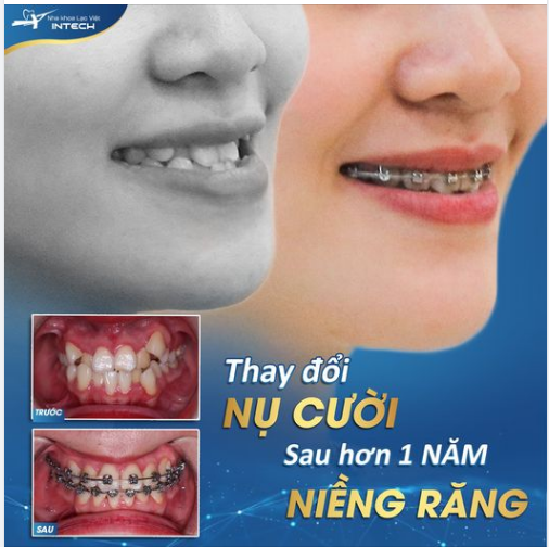 TỪNG BỊ GẮN MÁC “CƯỜI TOÀN RĂNG”, CÔ GÁI TỰ TIN SAU HƠN 1 NĂM ĐEO NIỀNG