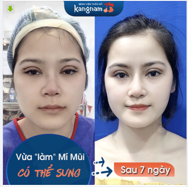 Từng lo lắng vì NÂNG MŨI CẮT MÍ cùng lúc sẽ SƯNG, LÂU HỒI PHỤC