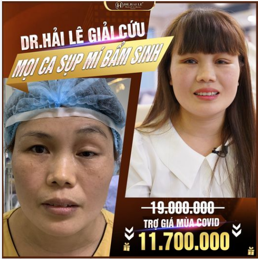 Tus dành riêng cho KH Sụp mí bẩm sinh
