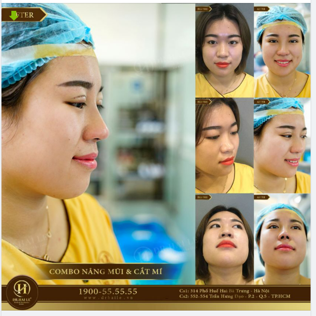 Tus dành riêng cho tín đồ làm đẹp đang có ý định Nâng mũi/ Cắt mí !!!