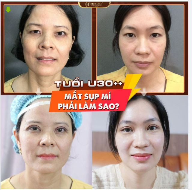 U30++ Mắt sụp mí già nua phải làm sao?
