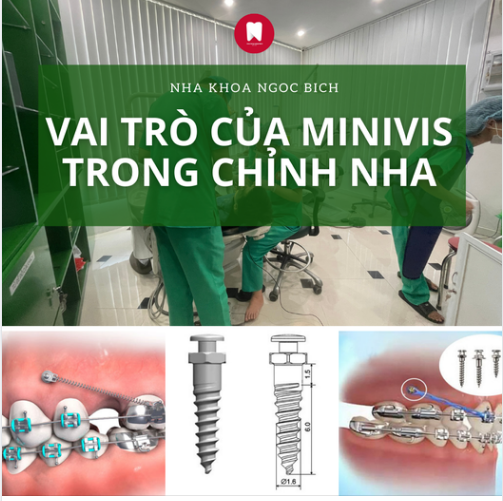 VAI TRÒ CỦA MINIVIS TRONG CHỈNH NHA