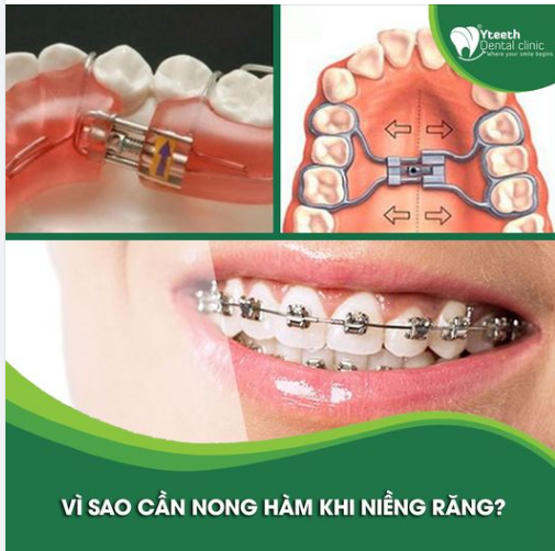 VÌ SAO CẦN NONG HÀM KHI NIỀNG RĂNG?