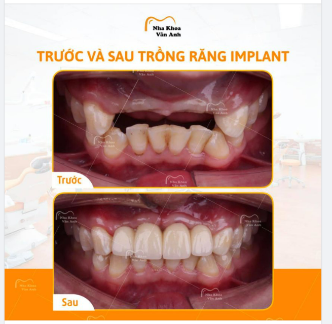 VÌ SAO NÊN TRỒNG RĂNG IMPLANT