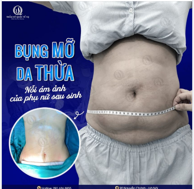 Vùng bụng trở nên nhiều mỡ, chảy xệ, rạn da khiến thân hình mất cân đối mà không thể khắc phục được dù đã cố tập luyện và ăn kiêng