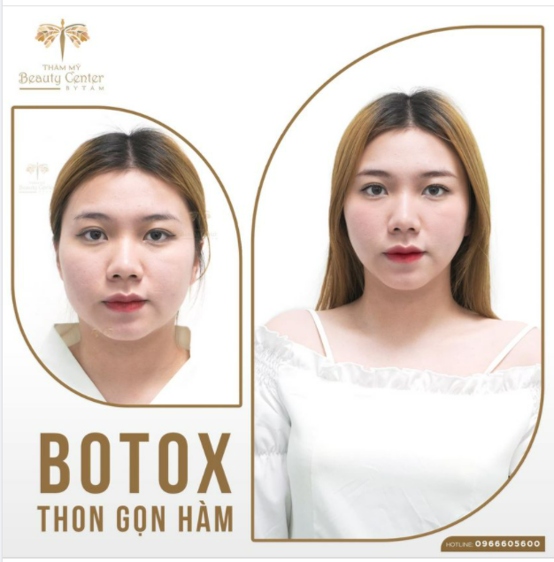 Xem ngay kết quả thon gọn mặt bằng botox của khách hàng tại Thẩm mỹ Beauty Center by Tấm sau 1 tháng để biết câu trả lời.