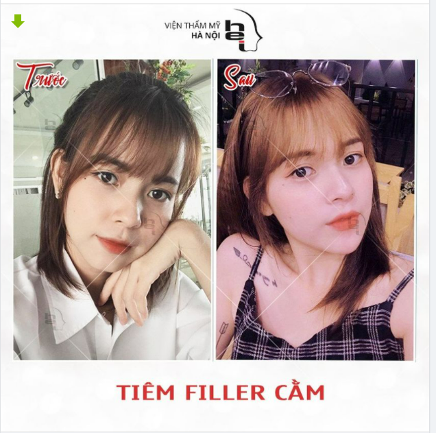 XINH ĐẸP HƠN với dáng cằm Vline KHÔNG PHẪU THUẬT.