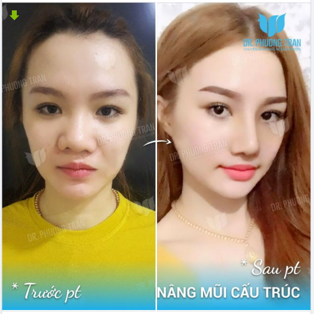 XINH ĐẸP, TỰ TIN HƠN SAU NÂNG MŨI