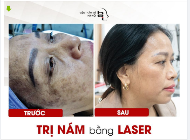 Xóa mờ nám chỉ sau 1 liệu trình