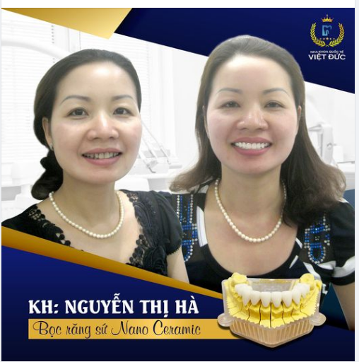 Xóa Sổ Răng Xỉn Màu - Thay Màu Răng Trắng Sáng