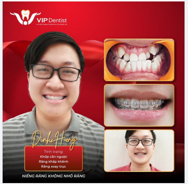 XỬ GỌN KHỚP CẮN NGƯỢC, RĂNG KHẤP KHỂNH, XOAY TRỤC - NIỀNG RĂNG KHÔNG NHỔ RĂNG