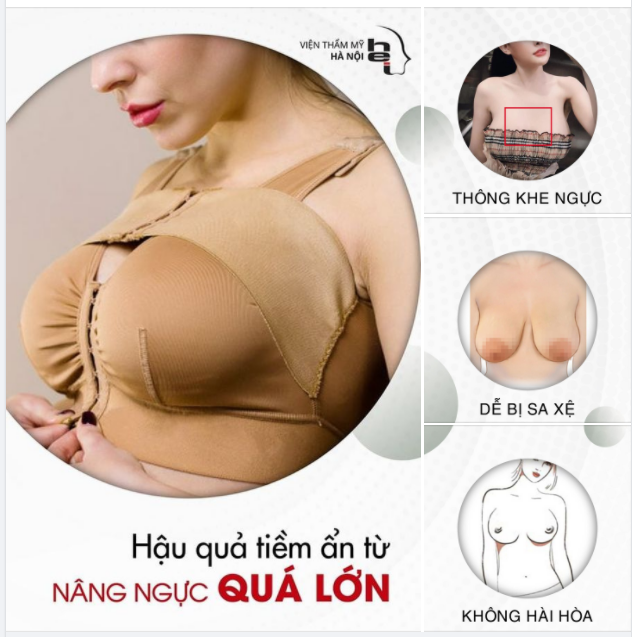 Xu hướng gần đây các chị em nâng ngực với thể tích (Size) lớn so với cơ thể người VN.
