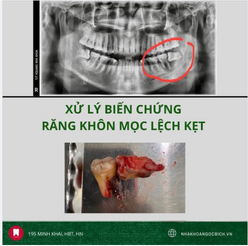 XỬ LÝ CASE BIẾN CHỨNG NẶNG NỀ TỪ RĂNG KHÔN MỌC LỆCH
