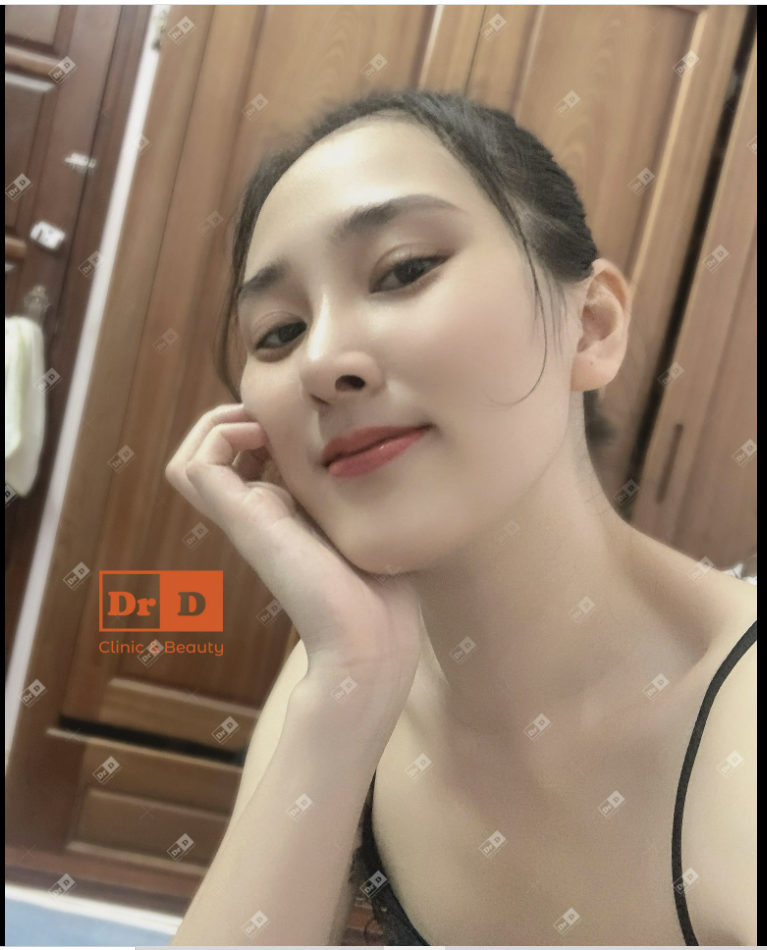 1 chiếc ảnh chân thật về dáng mũi Perfect Dform sau 20 ngày.