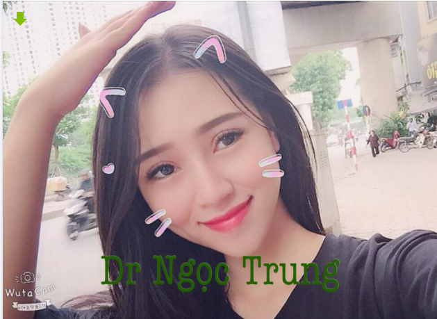 Sự thay đổi rất lớn chỉ sau 10 ngày của bạn gái thực hiện combo nâng mũi Sline và cắt mí minideep .