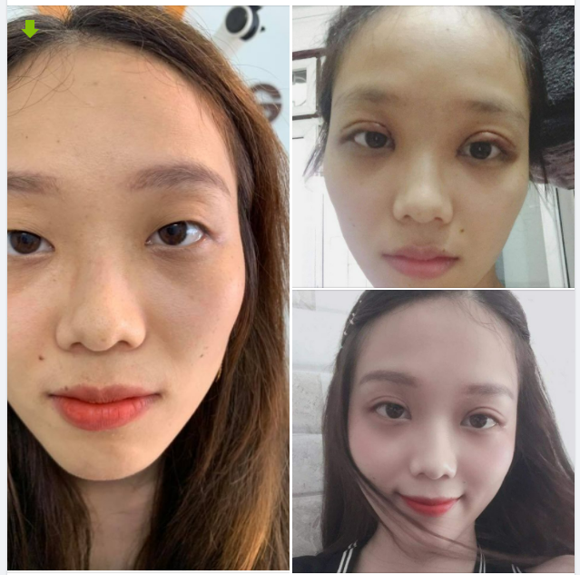 Ảnh bạn gái trước- ngay sau cắt mí và sau đó 2 tuần đây ạ.