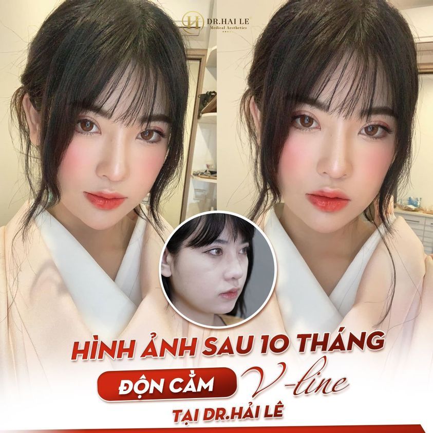MẶT V-LINE "SIÊU NÉT" - TẠM BIỆT CẰM "NGẮN LẸM"