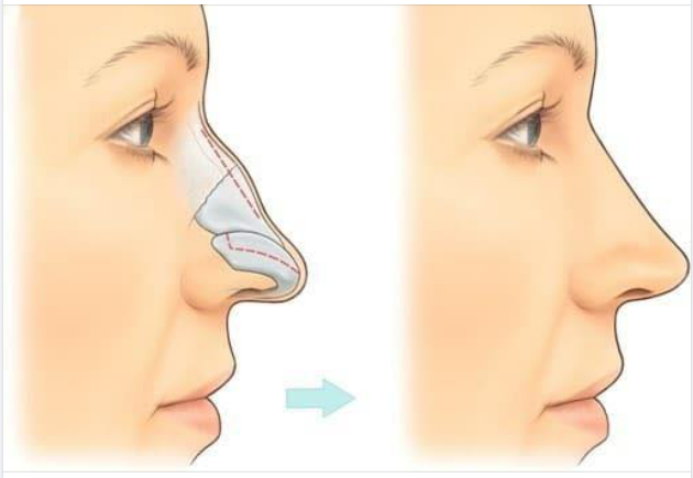 SỬA MŨI GỒ - LƯU Ý CHO NGƯỜI CHƯA TỪNG PHẪU THUẬT!!