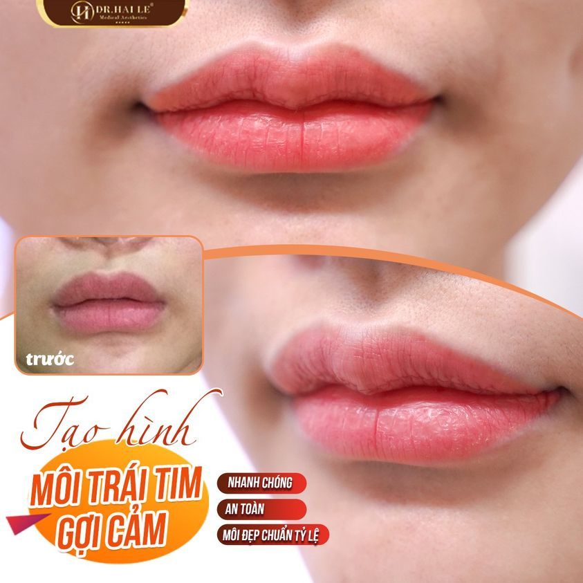 Tạo hình môi tim gợi cảm với ưu đãi lên tới 50% tại Dr.Hải Lê