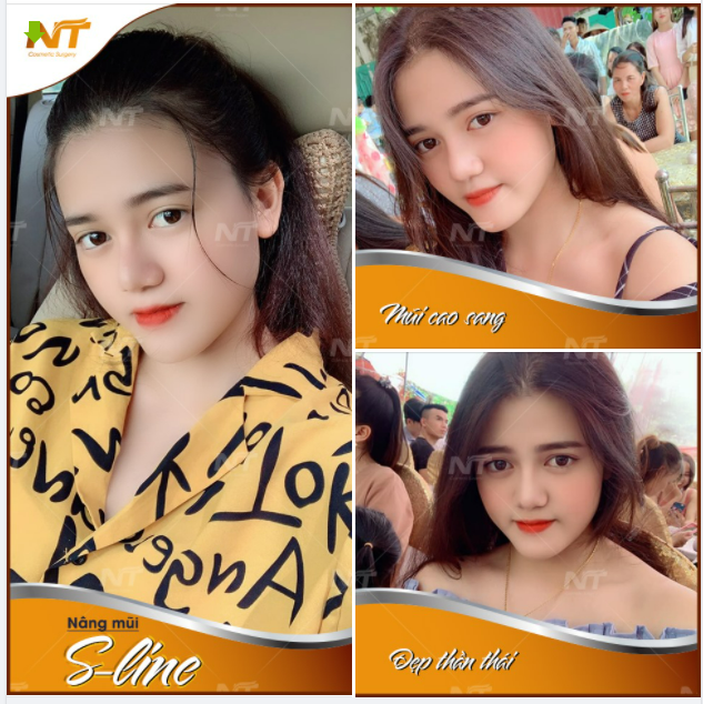 Nâng mũi S-Line – Mũi cao sang - Đẹp thần thái