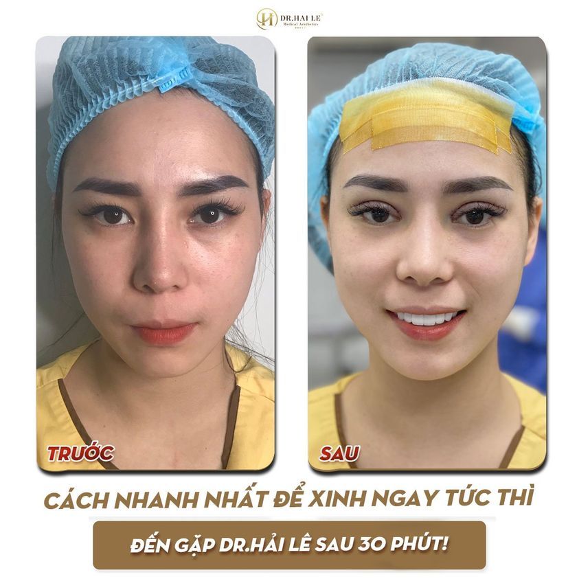 Mí lót "hoá" hai mí ​​​​​​​ Không đau - không sẹo - nếp mí bền đẹp tự nhiên