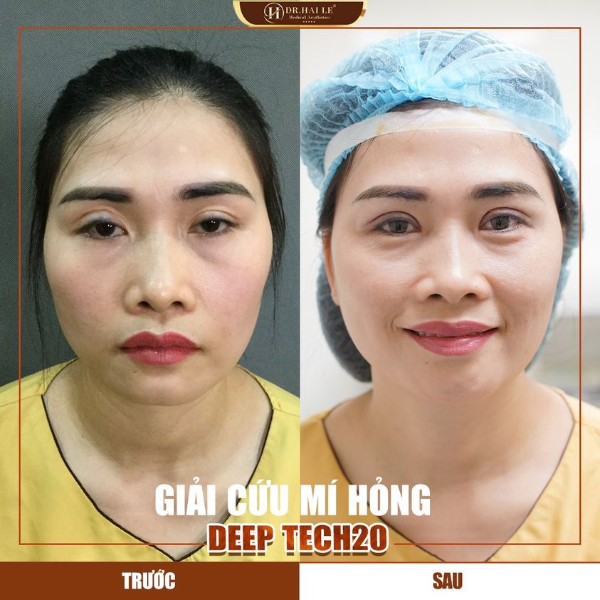 Giọt nước mắt hạnh phúc sau khi sửa mí lần thứ 5