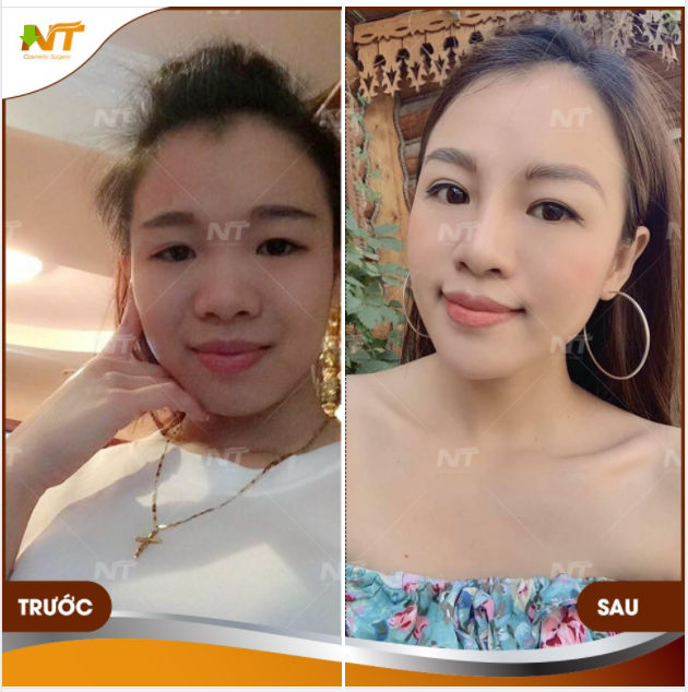 ​​​​​​​Ước mơ đôi mắt to tròn của khách hàng H đã biến thành sự thật