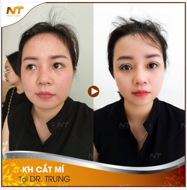 Feedback Khách hàng CẮT MÍ MINI DEEP sau 2 tuần tại DR Ngọc Trung