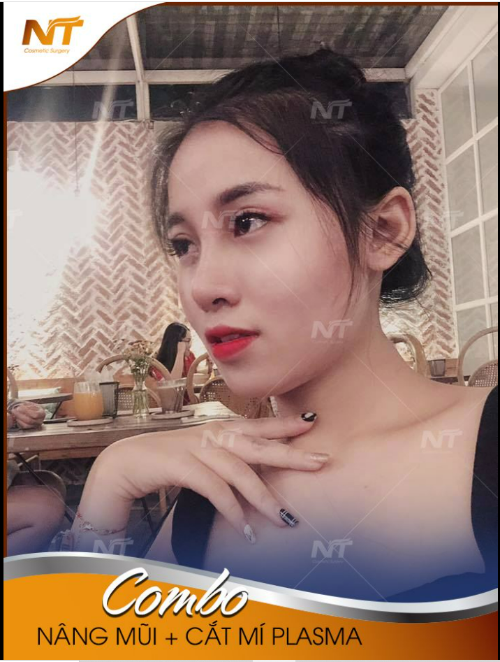 Feedback khách hàng 7 ngày sau khi thực hiện combo mũi + mí plama