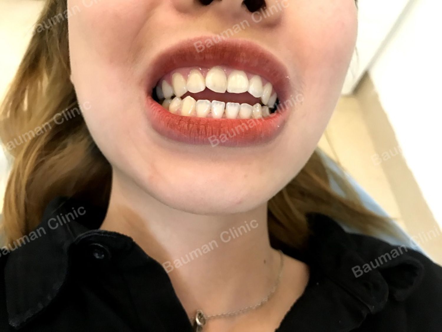 Ca niềng răng số 5005 - Nha khoa Bauman Clinic