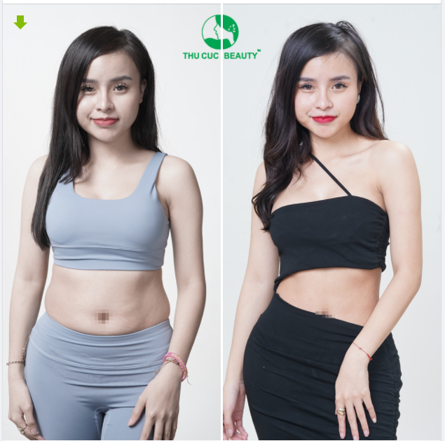 THẨM MỸ V2 SẠCH KHUẨN - GIẢM MỠ THẦN TỐC
